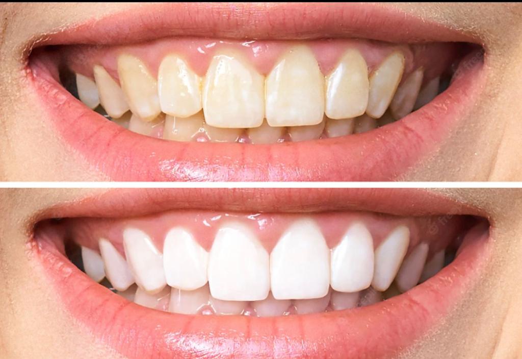 Before and After Teeth